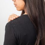 علت های اصلی ایجاد شوره سر و روش های کنترل آن
