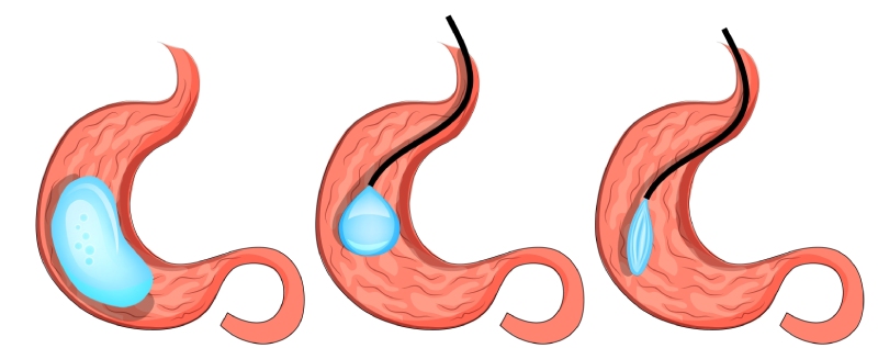 بوتاکس معده در شرایط اضطراری: چه کسانی واجد شرایط هستند؟