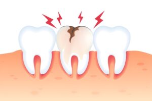 پوسیدگی دندان، زنگ خطری برای سلامت کل بدن