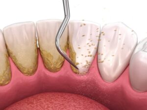 آیا جرم‌ گیری باعث ایجاد فاصله بین دندان‌ ها می‌ شود؟ بررسی علمی و نکات مراقبتی