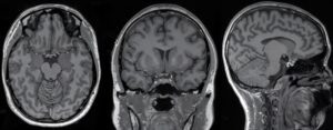 زیرنویس ذهنی: فناوری نوین تبدیل افکار به متن با تحلیل MRI مغز