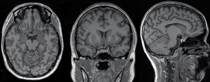 زیرنویس ذهنی: فناوری نوین تبدیل افکار به متن با تحلیل MRI مغز