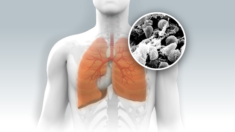 طاعون چگونه تشخیص داده می شود؟