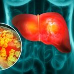 کبد چرب ۵ زیرگروه متفاوت دارد؛ کدام نوع خطر بیشتری برای سلامت دارد؟
